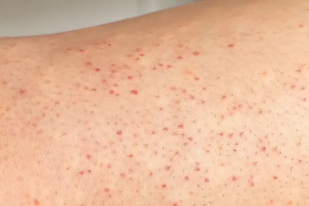 Tratamiento para Foliculitis