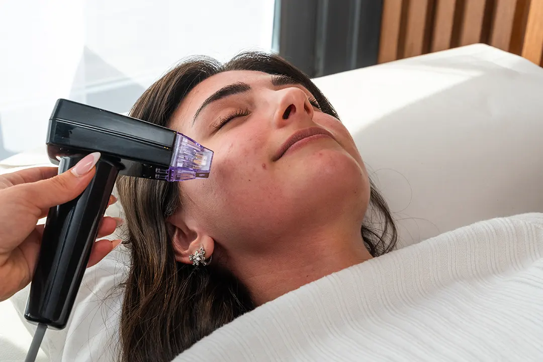 Radiofrecuencia Fraccionada Facial
